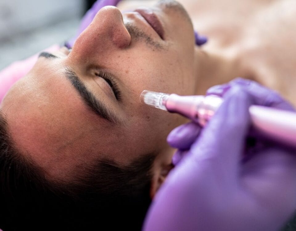 Microneedling treatment in Miami
