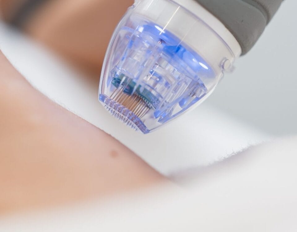 Microneedling in Miami