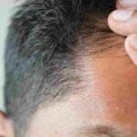 hair-restoration-before-and-after