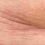 wrinkle relaxer treatment