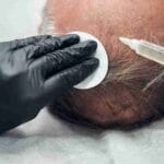 anteage exosome hair treatment side effects
