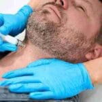 mesoneedling treatment guide