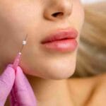 lip fillers miami