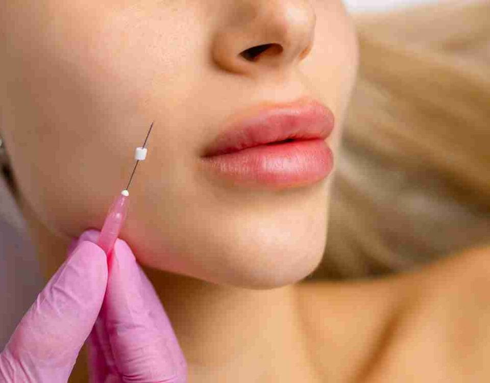 lip fillers miami