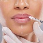 miami lip fillers