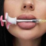 lip fillers near me