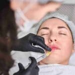 best lip fillers near me