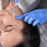 best botox coral gables