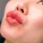 lip fillers coral gables