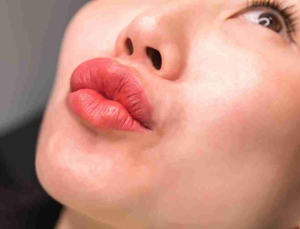 lip fillers coral gables