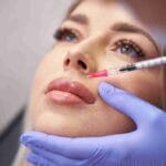 lip fillers miami fl