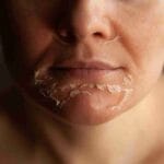 chemical peel benefits