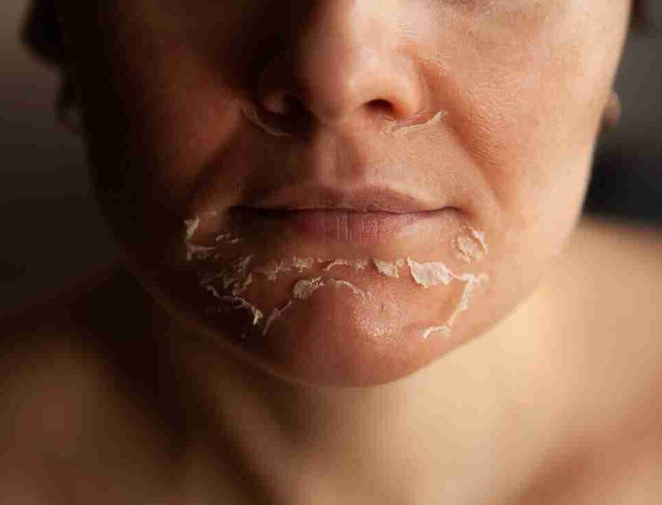 chemical peel benefits