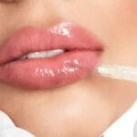 best lip augmentation miami