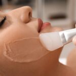 best chemical peel for hyperpigmentation