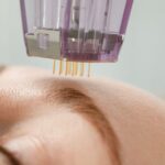 microneedling with radiofrequency
