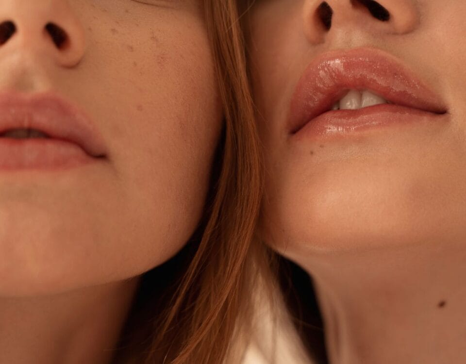 Comparing permanent vs temporary lip fillers Miami. Learn about the safety, cost, reversibility, and long-term ROI of modern lip augmentation options.