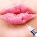 miami-lip-filler-trusted-injector