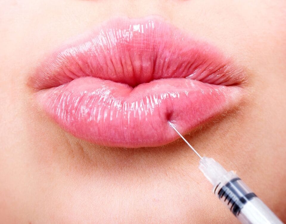 miami-lip-filler-trusted-injector