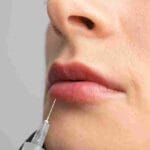 lip augmentation miami cost