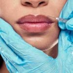 Get expert lip filler recovery and aftercare tips in Miami to heal faster and protect your results from day one.