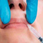 Want a natural lip filler look? Discover tips, techniques, and why Pōk Aesthetic Bar in Coral Gables, FL delivers beautifully subtle results.