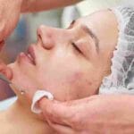 med-spa-acne-scar-treatment-miami
