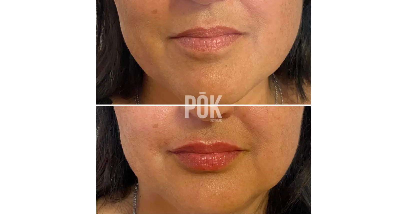 hyaluronic acid fillers