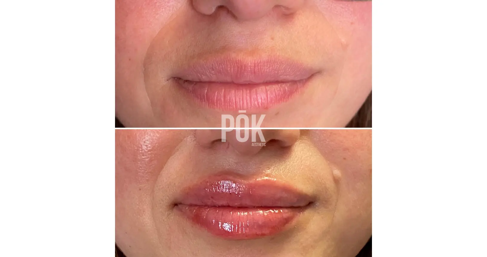 lip fillers in coral gables