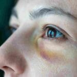 botox-bruising-tips