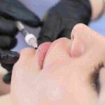 Learn what to expect from hyaluronic acid lip filler — costs, results, aftercare, and why Coral Gables patients love it.