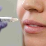 how-much-lip-filler
