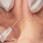 can-aesthetician-inject-botox