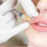 Why Get Lip Fillers? What Patients Say After 1 Year